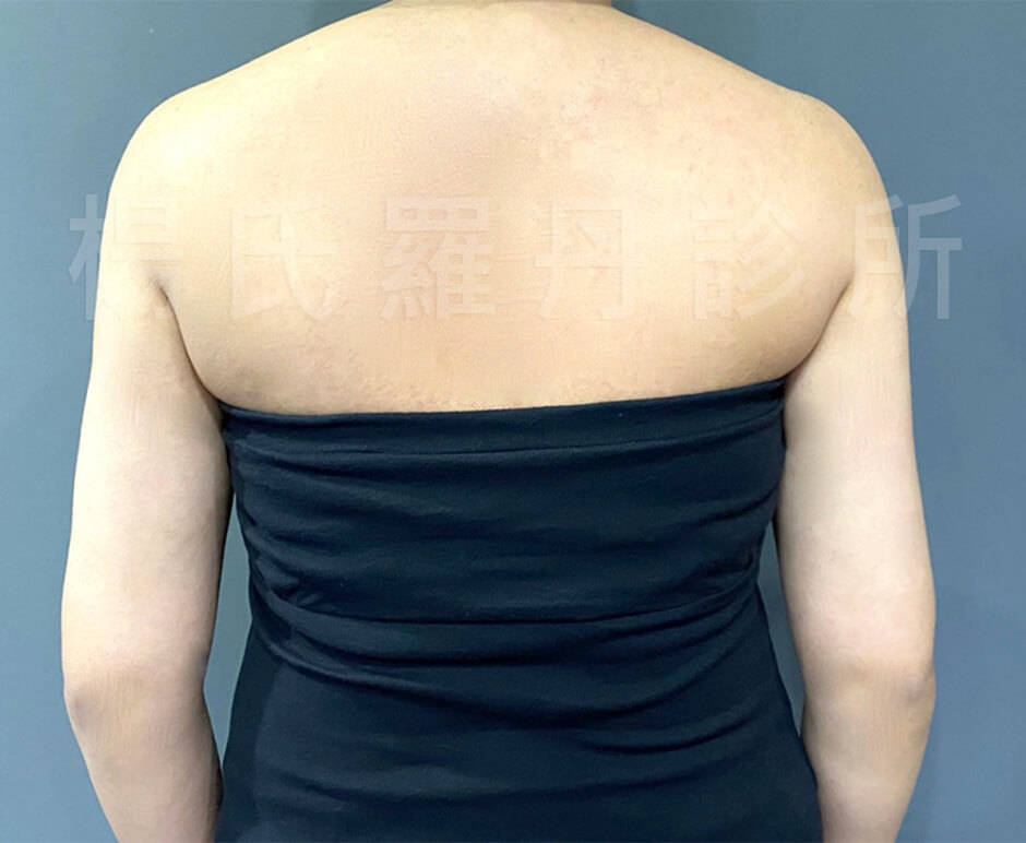 雷射減脂  抽脂肪 瘦手臂 手臂 減脂手術